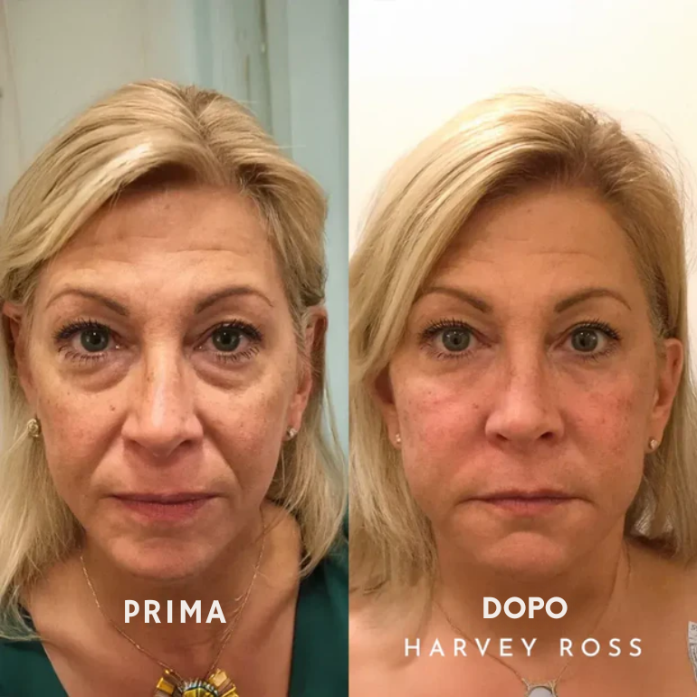 Harvey Ross - Lifting Instantaneo Facile